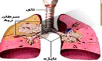 دلايل و علائم سرطان ريه